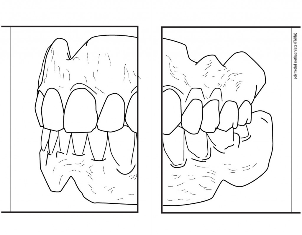 Polymethyl methacrylate (PMMA) | dentures